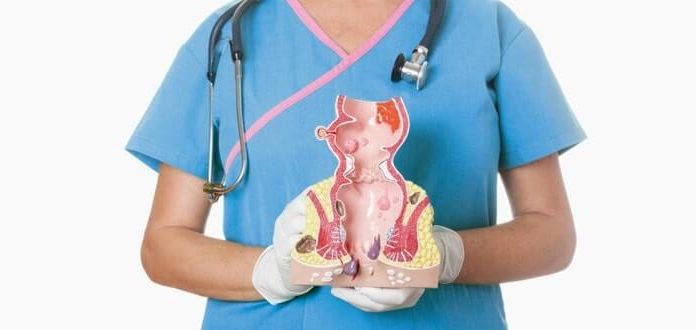 Основные признаки геморроя